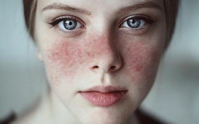 Dấu hiệu lupus ban đỏ và giải pháp cải thiện từ thảo dược