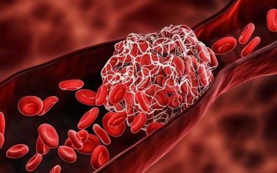 Cảnh giác với hội chứng cục máu đông hậu COVID-19