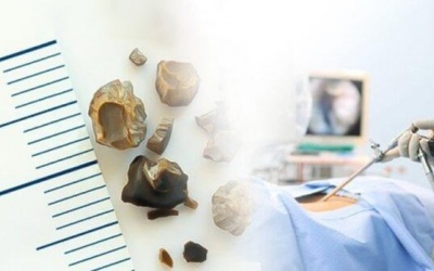 Mổ sỏi túi mật có ảnh hưởng gì tới sức khỏe không?