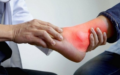 Gout cấp và liệu pháp cải thiện an toàn từ thảo dược