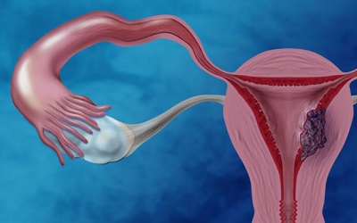 Thừa cân làm tăng gấp đôi nguy cơ ung thư nội mạc tử cung