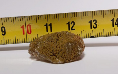 Sỏi mật 10mm dùng Kim Đởm Khang được không?