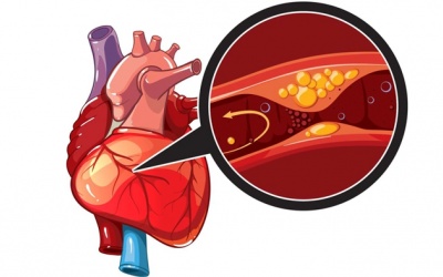 Thiếu máu cơ tim, ngoại tâm thu kèm đái tháo đường điều trị ra sao?
