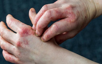 Lưu ý khi chăm sóc da trong mùa hè cho người bị viêm da cơ địa