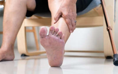 Đái tháo đường kèm xơ vữa động mạch, châm chích bàn chân phải làm sao?
