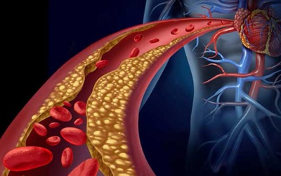 Cách kiểm soát mỡ máu không dùng thuốc hiệu quả