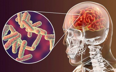 Nguyên nhân chủ yếu gây ra viêm màng não là gì?