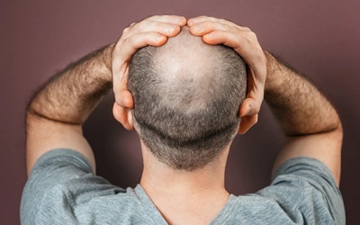 Giải mã những yếu tố dẫn tới hói đầu ở nam giới