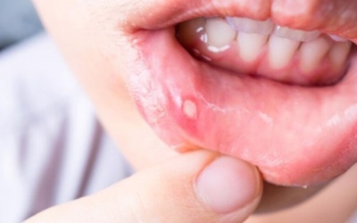 Vì sao nhiệt miệng hay tái phát?