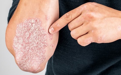 “Sống chung” với bệnh vảy nến thể mảng như thế nào?
