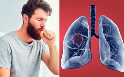 Một số dấu hiệu nhận biết ung thư phổi giai đoạn đầu 