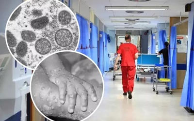 Việt Nam giám sát người đến từ 12 quốc gia lưu hành bệnh đậu mùa khỉ 