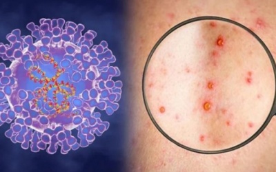 Bộ Y tế khuyến cáo 6 biện pháp phòng ngừa bệnh đậu mùa khỉ