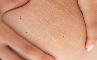 Làm thế nào để không còn nỗi ám ảnh với rạn da?