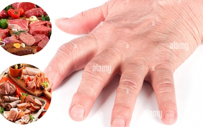 Giải đáp: Người bị viêm đa khớp nên kiêng ăn gì?