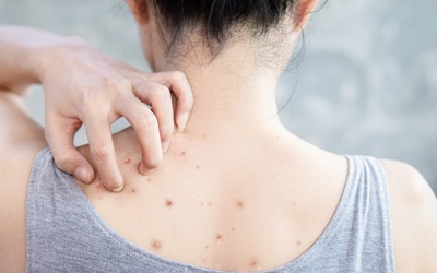 Hè đến, làm sao để giảm mụn lưng?