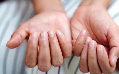 Bạn có đang thiếu sắt? Dấu hiệu cảnh báo và cách cải thiện