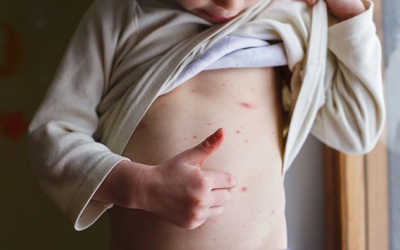 Những lưu ý quan trọng khi trị thủy đậu tại nhà 