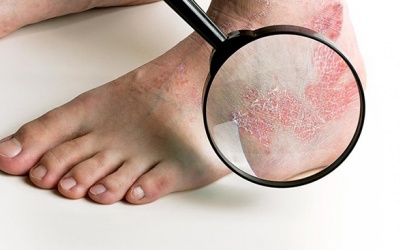 Bị vảy phấn hồng nên kiêng gì?