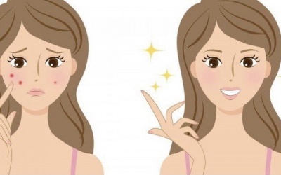 4 bước chăm sóc da giúp cải thiện mụn hiệu quả