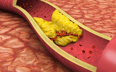 Thời tiết thất thường, người huyết áp, mỡ máu cao, tim mạch coi chừng bị xơ vữa động mạch 