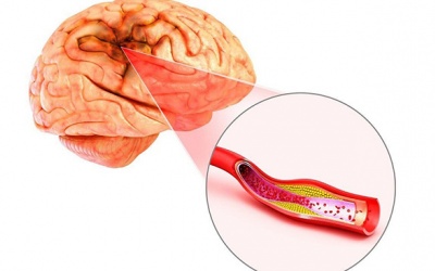“Thủ phạm” gây xuất huyết não bạn cần biết