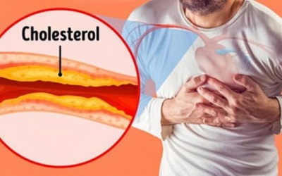 Cách phòng ngừa nguy cơ xơ vữa động mạch ở người huyết cáp cao, mỡ máu cao, tim mạch