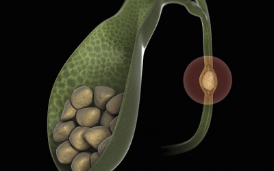 Chuyên gia tư vấn: Sỏi mật 8,7mm có nguy hiểm không? 