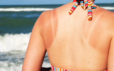 Mùa hè, cảnh giác với nguy cơ da bị ngộ độc nắng