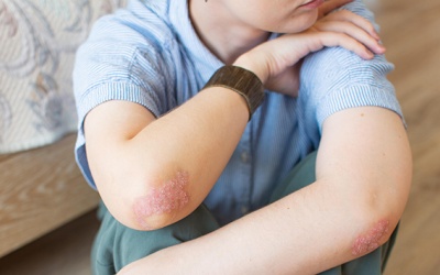 Cách bảo vệ hệ miễn dịch ở người bệnh vảy nến thể mảng