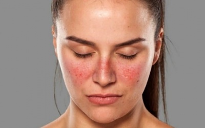 Lupus ban đỏ nguy hiểm như thế nào và cách cải thiện ra sao?