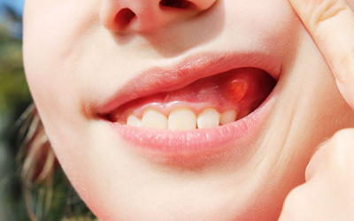 Viêm chân răng có mủ: Biến chứng nghiêm trọng với răng miệng