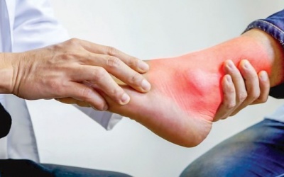 Bệnh nhân điều trị bệnh gout cần lưu ý gì?