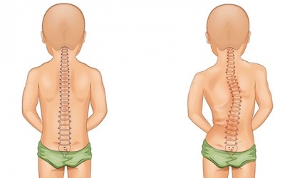 Cong vẹo cột sống ở lứa tuổi học đường và cách phòng tránh