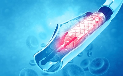Sau đặt stent mạch vành vẫn bị đau ngực phải làm sao?