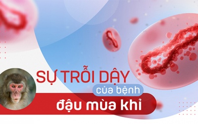 Sự trỗi dậy của bệnh đậu mùa khỉ
