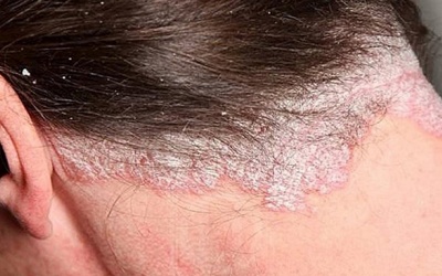 Vảy nến da đầu và tất tần tật những điều nên biết