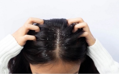 Làm sao để hết gàu?