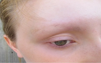 Tại sao lông mày của bạn mỏng đi?