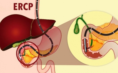 Sau nội soi mật tuỵ ngược dòng dùng TPBVSK Kim Đởm Khang được không?