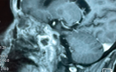 Bộ Y tế lên tiếng về chứng bệnh hoại tử xương mặt