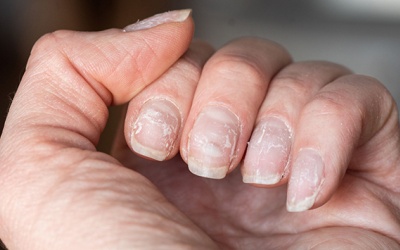 Cách khắc phục tình trạng móng tay giòn, dễ gãy