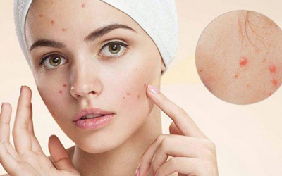 “Thủ phạm” gây mụn bọc ở mũi