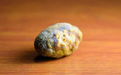 Sỏi mật 20,6mm dùng TPBVSK Kim Đởm Khang được không?