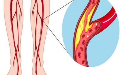 Triệu chứng suy giảm tuần hoàn ở người bệnh tim mạch