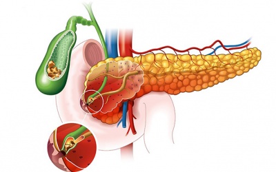 Sỏi túi mật 8,1mm gây đau bụng, khó tiêu phải làm sao?