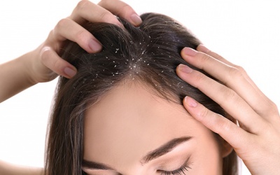 Cách phân biệt, xử trí vảy nến da đầu và gàu tóc