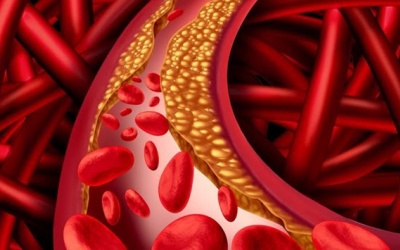 Phòng ngừa và điều trị xơ vữa động mạch như thế nào?
