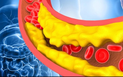Chế độ dinh dưỡng cho người mỡ máu cao như thế nào?