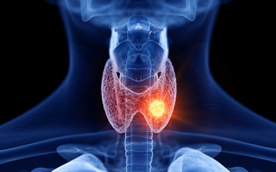 Triệu chứng của u tuyến giáp lành tính là gì? 